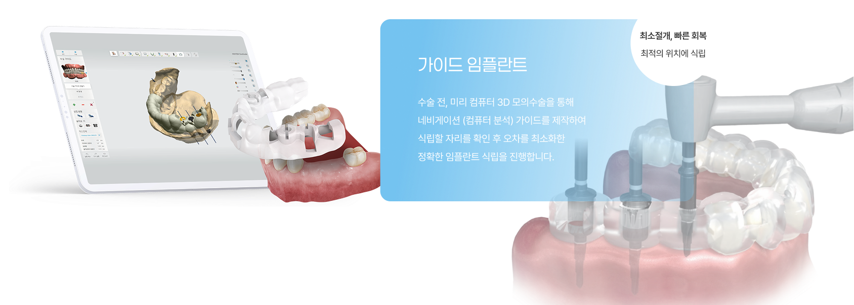 일반 임플란트 1