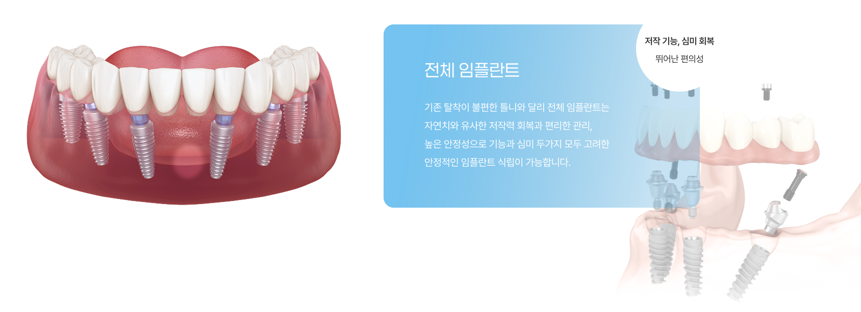 일반 임플란트 3